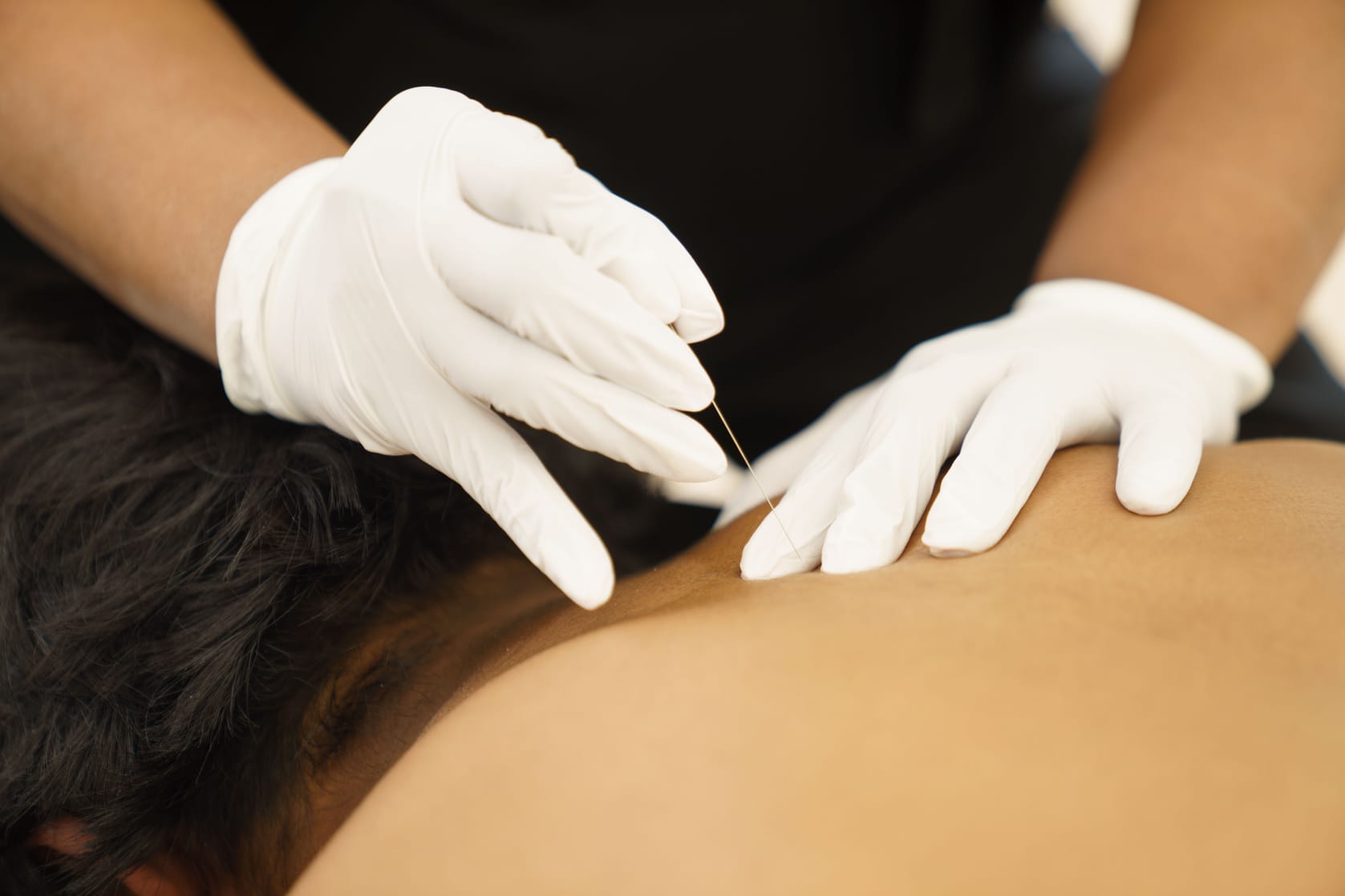 Acupuncture/ Dry Needling Therapy